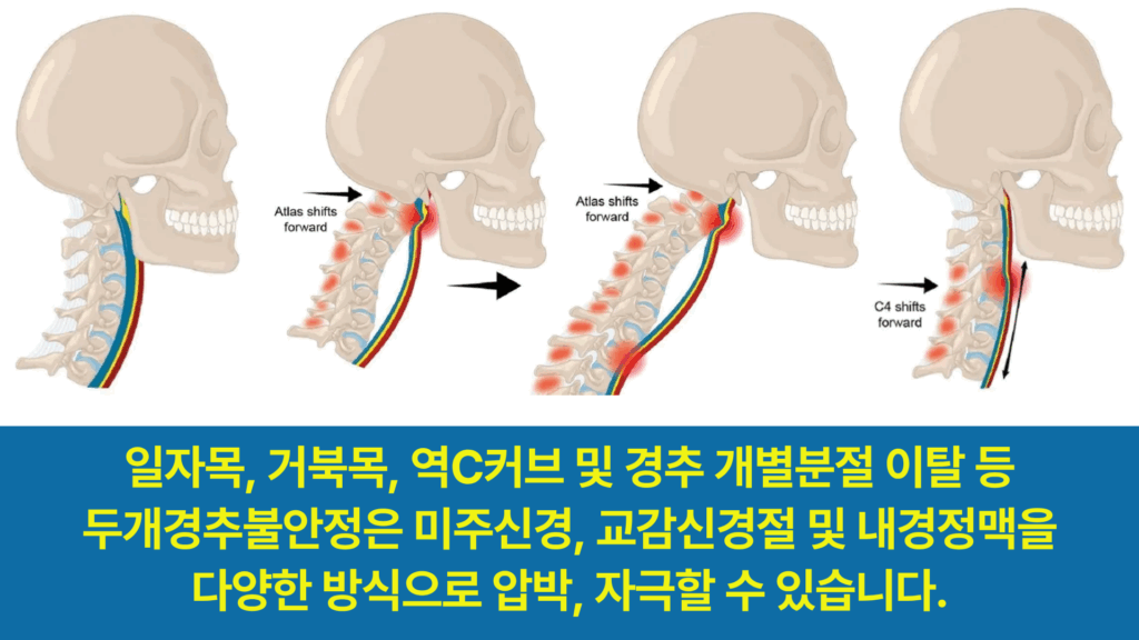 일자목, 거북목, 역C커브 및 개별분절 이탈은 어지럼증, 이석증, 현기증의 배경이 됩니다