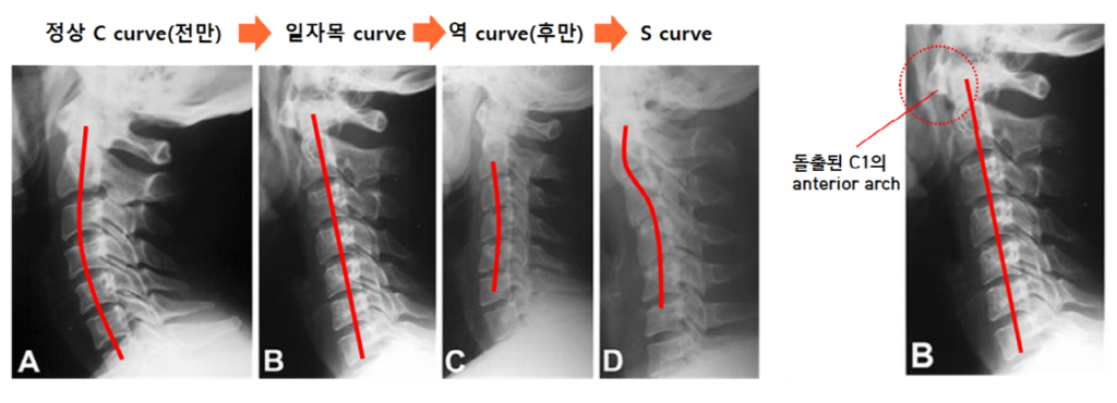 경추 커브의 변형과 이탈