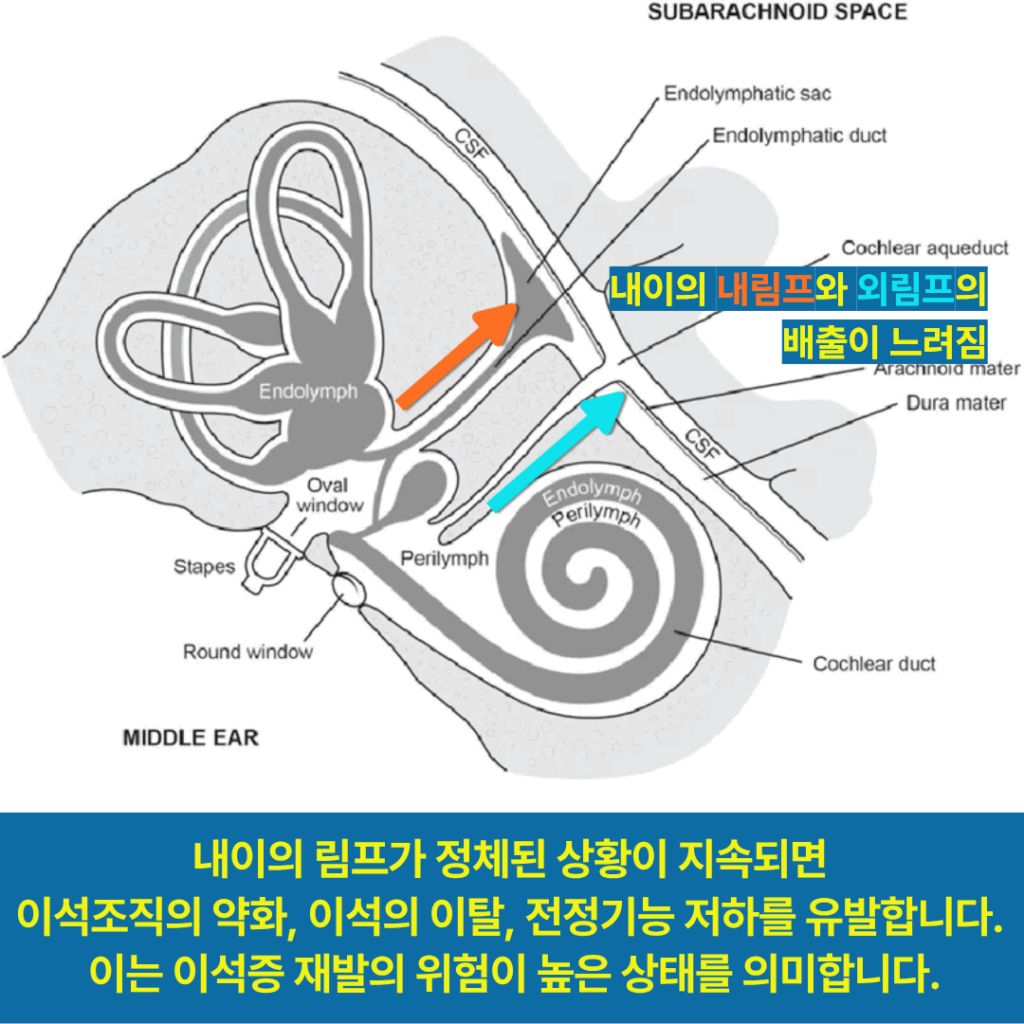 내이의 림프 정체는 이석증 재발의 위험이 높은 상태를 의미합니다