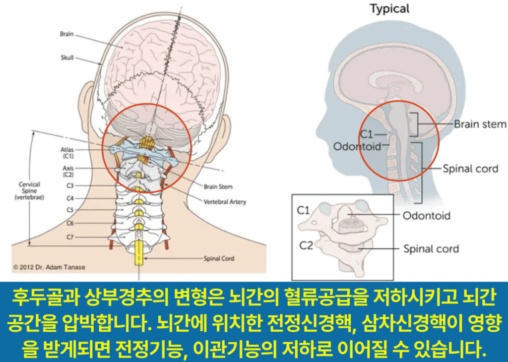후두골과 상부경추의 변형은 뇌간을 압박하고 허혈을 유발하고 전정기능, 이관기능의 저하로 이어집니다.