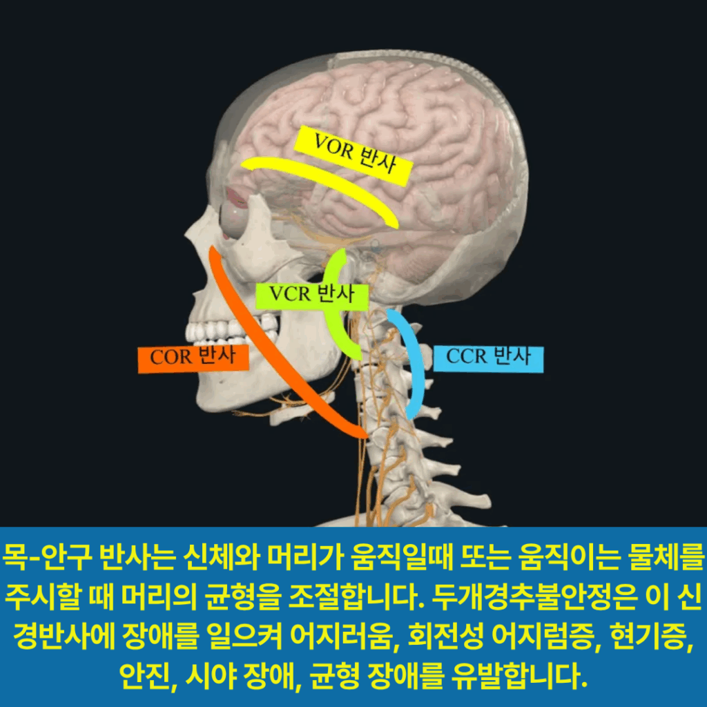 목-안구반사 장애는 어지럼증, 현기증, 이석증에 동반.