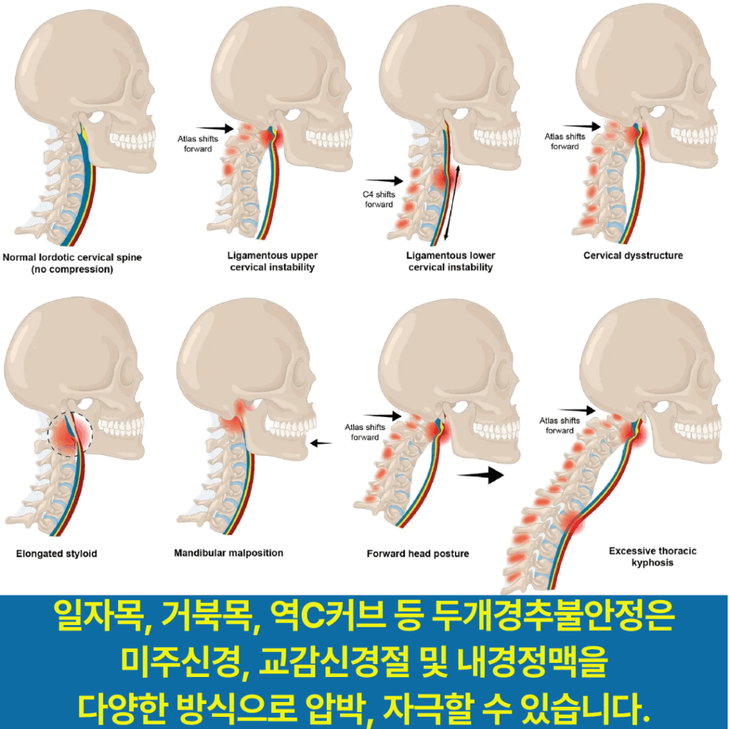일자목, 거북목, 역C커브는 미주신경, 교감신경절, 내경정맥에 스트레스를 가해 어지럼증에 자율신경실조를 동반