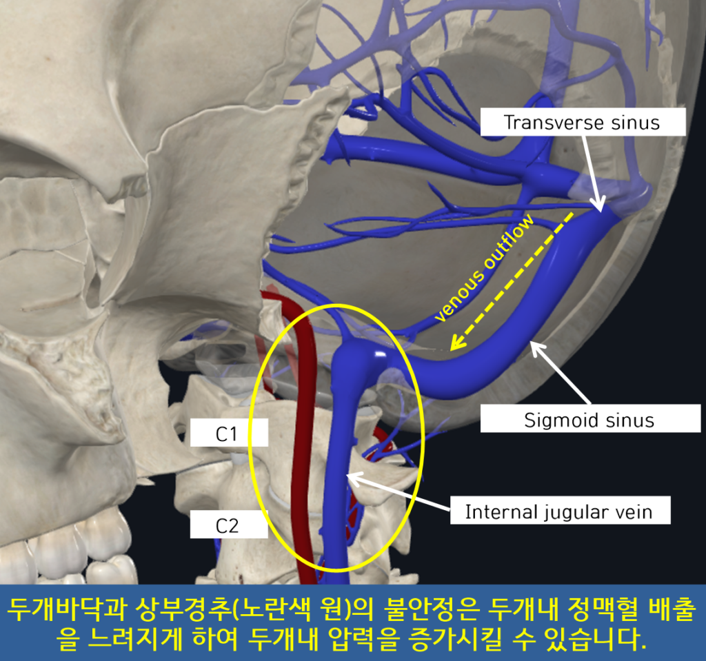 두개경추불안정은 두개내 정맥혈 배출을 느려지게 하여 두개내 압력을 증가시킬수 있습니다