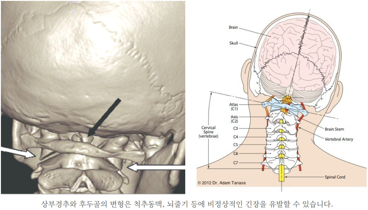 두개경추불안정 증후군 - 이수척한의원